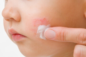 Young adult mother finger applying white medical ointment on toddler boy cheek isolated on light gray background. Red rash on skin. Allergy from food. Care about baby body. Closeup. Front view.