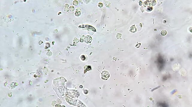 Microscopic footage of urine sediment showing bacteria, leukocytes, and epithelial cells. Useful for medical, healthcare, diagnostic, laboratory, and microbiology concepts.