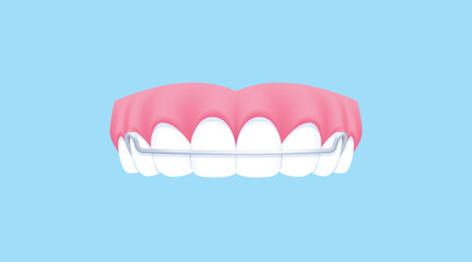 Upper teeth (Hawley retainer) illustration vector design. Dental care concept.