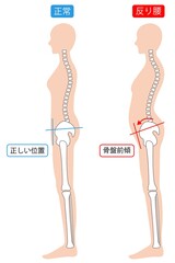 反り腰と正常な姿勢の女性　背骨と骨盤