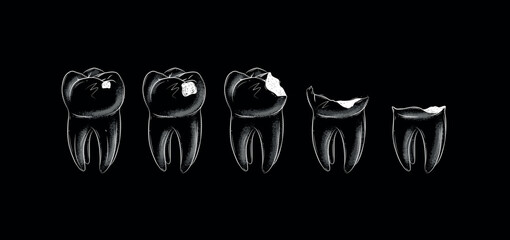 Life cycle of dental caries illustration drawing in graphic style with white on black background. © anna42f