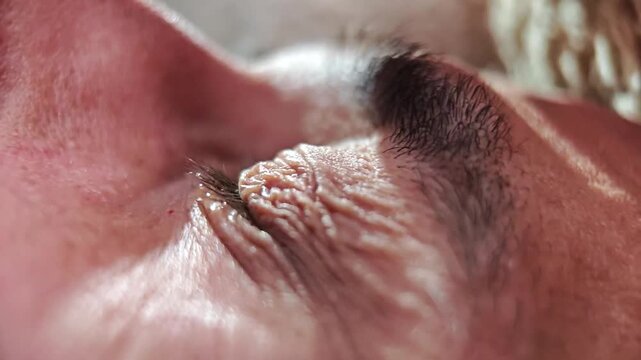 Medical eye drop falling onto a human eyeball for treatment.