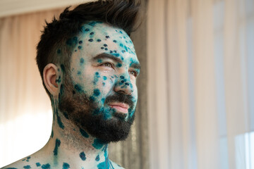 Adult man face with strong aggressive varicella or chicken pox. Pink spots, papules, vesicles. Treatment of chickenpox with brilliant green Zelenka.