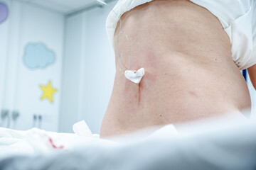 Close-up of a patient's lower back showing an epidural catheter and gauze dressing, highlighting post-operative care and pain management in a hospital setting