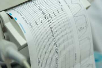 Cardiotocography ctg machine is printing a paper recording of fetal heartbeat and uterine contractions during labor, providing crucial information for monitoring fetal well-being