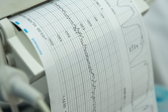 Cardiotocography ctg machine is printing a paper recording of fetal heartbeat and uterine contractions during labor, providing crucial information for monitoring fetal well-being