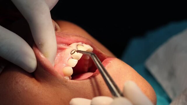 Close-up of dentist carefully removing gingival retraction cord from under the gum after dental impression procedure. Concept of precision dentistry and prosthetic preparation.