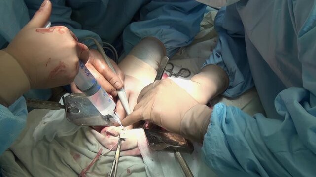 In a surgical setting, physicians wearing gloves and gowns, use a syringe and surgical tools for a procedure. The sterile environment provides a safe space for medical intervention.