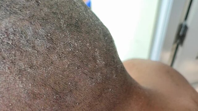 Close-up of a bald man's head with seborrheic dermatitis and dandruff. Concept of scalp health problems with seborrhea, seborrheic dermatitis or dandruff