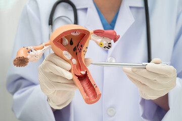 Uterus, doctor holding human anatomy model for study diagnosis and treatment in hospital.