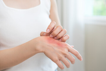 Obraz premium Dermatology asian young woman allergy, allergic reaction from atopic, insect bite, scratching itchy back of hand, red spot or rash of skin. Healthcare treatment of beauty. Isolated on white background