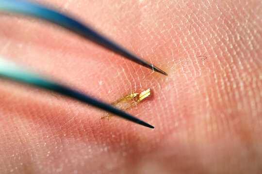 Macro detail of leg and foot skin injury caused by wooden splinter with close view of tweezers removing fragment, pain, discomfort, wound care, and medical treatment procedure