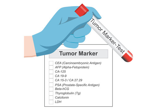 Tumor marker is a substance used to help detect diagnose and monitor the treatment or recurrence of cancer in the body.