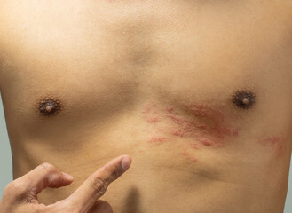 Skin of a man with Herpes zoster or Shingles