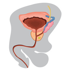 Diagram of prostate cancer illustration. Vector illustration