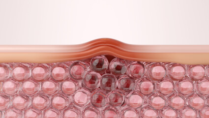 Cross Section of Acne Papule and Skin Inflammation, 3D Illustration