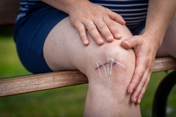 Close up of knee injury treated with stitches and wound closure strips