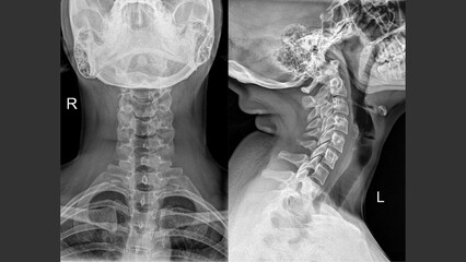 X-ray of cervical spine showing native vertebral anatomy – AP and lateral views