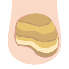 爪甲鉤彎症の爪