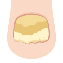 爪白癬・爪水虫