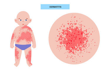 Dermatitis medical poster