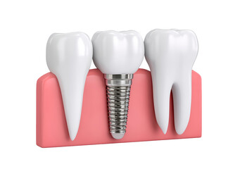 Dental implant model with healthy teeth and gums illustrated on transparent background, PNG