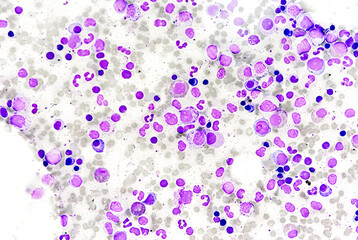 Bone marrow study: Suggestive of Erythroid hyperplasia