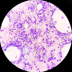 Bone marrow study: Suggestive of Erythroid hyperplasia