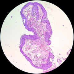 Photomicrograph of a pterygium of conjunctiva, with prominent degenerative changes of solar elastosis, related to exposure to ultraviolet (UV) light.