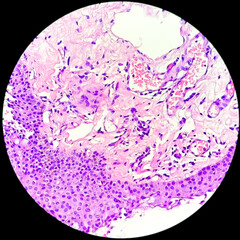 Photomicrograph of a pterygium of conjunctiva, with prominent degenerative changes of solar elastosis, related to exposure to ultraviolet (UV) light.