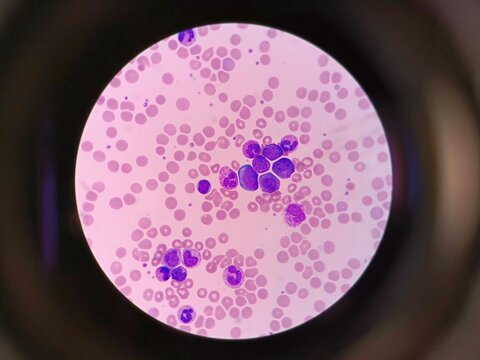 Blood Pathology Under Microscope &ndash; Medical Analysis 