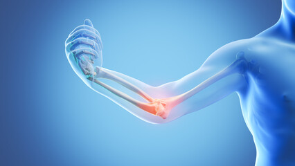 X-ray image of a blue human elbow with painful spots highlighted in red.