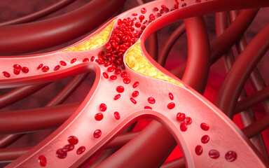 3d illustration of narrowed blood vessel due to atherosclerosis, Symptoms of high cholesterol in the blood
