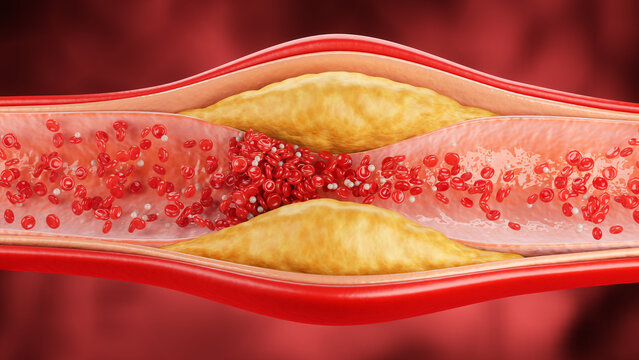 3d illustration of narrowed blood vessel due to atherosclerosis, Symptoms of high cholesterol in the blood