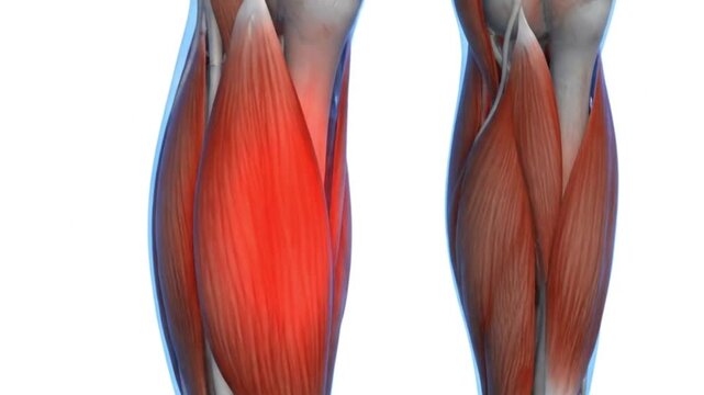 A medical illustration of shin splints showing tibialis anterior muscle inflammation a common lower leg injury from overuse or repetitive athletic strain