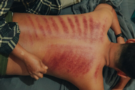 Kerokan or kerikan is a scraping Javanese traditional method of medicine to cure colds.