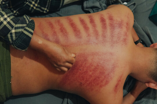 Kerokan or kerikan is a scraping Javanese traditional method of medicine to cure colds.