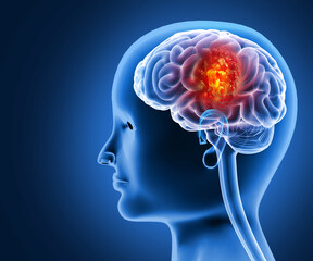 Brain tumor or barin cancer. 3d illustration