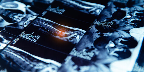 Mri scan of spine with disc protrusion highlighted in medical imaging, pinched sciatic nerve in leg