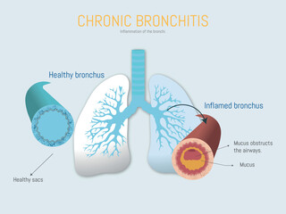 Chronic bronchitis showing inflamed and healthy bronchus comparison