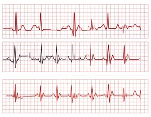 Multiple electrocardiogram heart rate readings