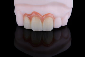 High-quality three dental crowns made of zirconium for fixation to the frontal teeth of upper jaw.