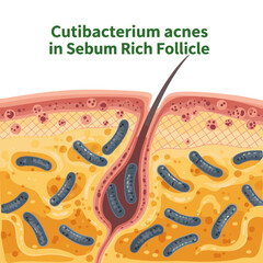 Fototapeta premium Cutibacterium acnes bacteria thriving within a sebum-rich hair follicle in human skin layers