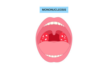 Mononucleosis symptoms poster