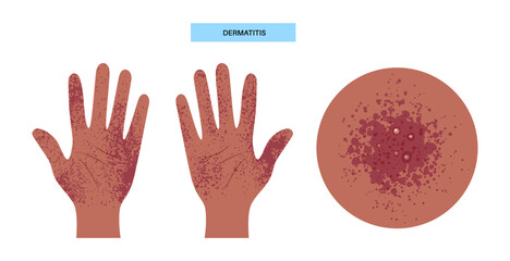 Fototapeta premium Dermatitis medical poster