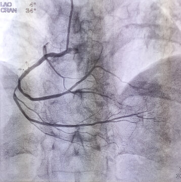 Coronary angiogram of right coronary artery during cardiac catheterization with contrast dye. Abnormal findings. colour adjust.