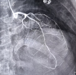 Coronary angiogram of left coronary artery during cardiac catheterization with contrast dye. Abnormal findings. Colour adjust.