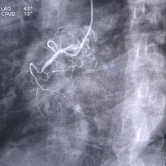 Coronary angiogram of right coronary artery during cardiac catheterization with contrast dye. RCA CTO findings. Colour adjust.