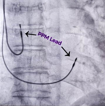 X ray image showed dual chamber permanent pacemaker (PPM) leads in left chest at Cath Laboratory.