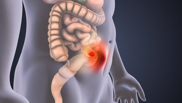 3D Animation Showing Formation of Abdominal Hernia